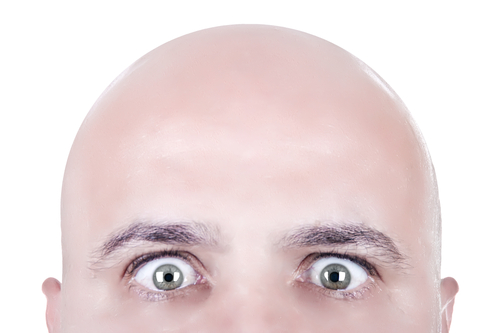 Imagen de hombre con calvicie androgenética