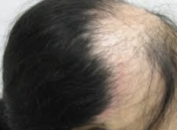 Imagen Alopecia Areata Inversus Ophiasis