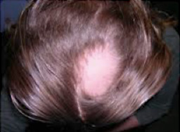 Imagen Alopecia Areata Irregular