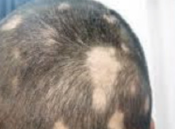 Imagen Alopecia Areata Reticular