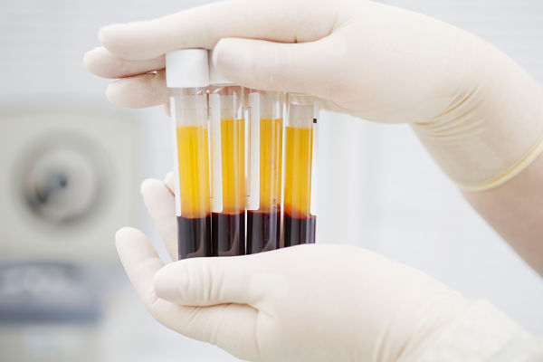Imagen de Plasma Sanguíneo Rico en Plaquetas y Dutasterida