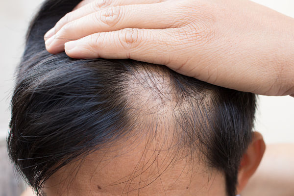 y Finasterida contra alopecia: ¿qué son para qué sirven?