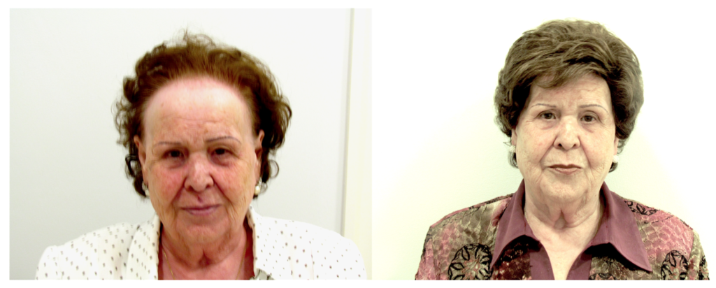 Imagen de mujer antes y después del Sistema de Integración Capilárea