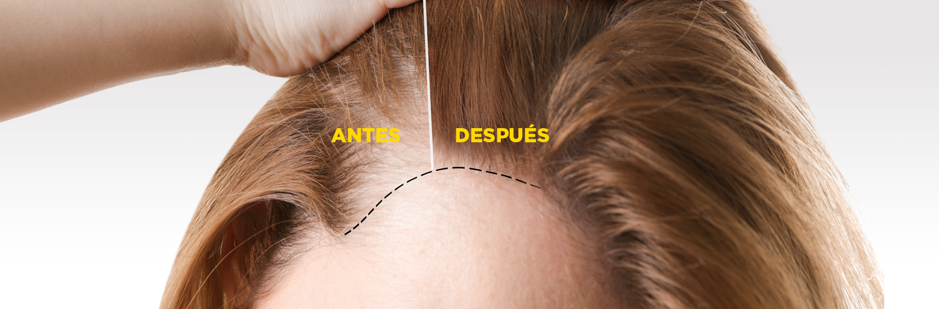 Mesoterapia Dutasterida y factores de crecimiento (PRP)
