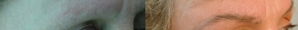 mujer tratada con alopecia en las cejas, Microinjerto de cejas antes y después
