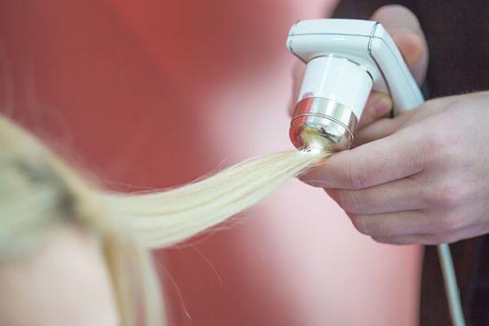 Tratamiento de láser capilar para alopecia femenina