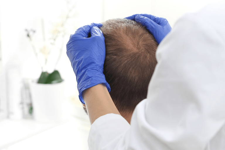 Alopecia y COVID grave: ¿cómo están relacionados?