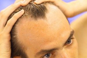 Alopecia Androgenética Masculina