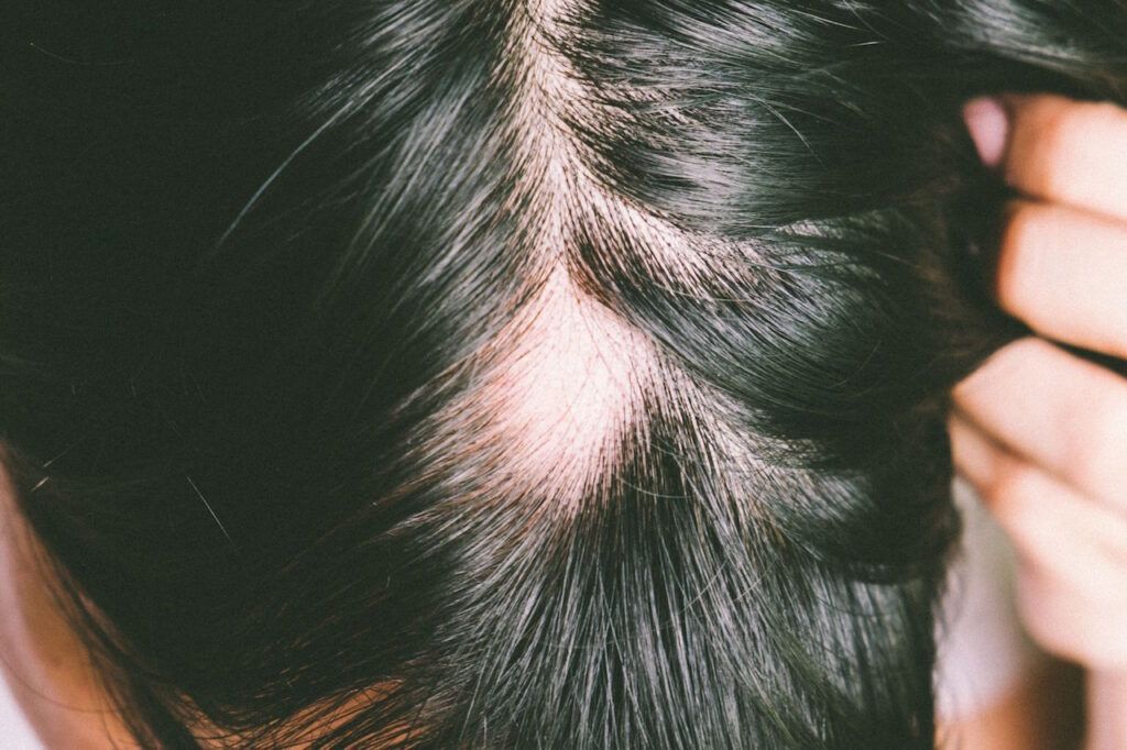 Alopecia Areata y estrés