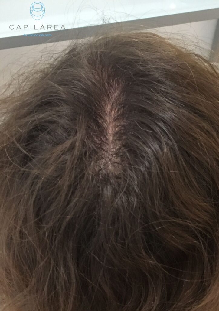 caso alopecia androgenética hombre