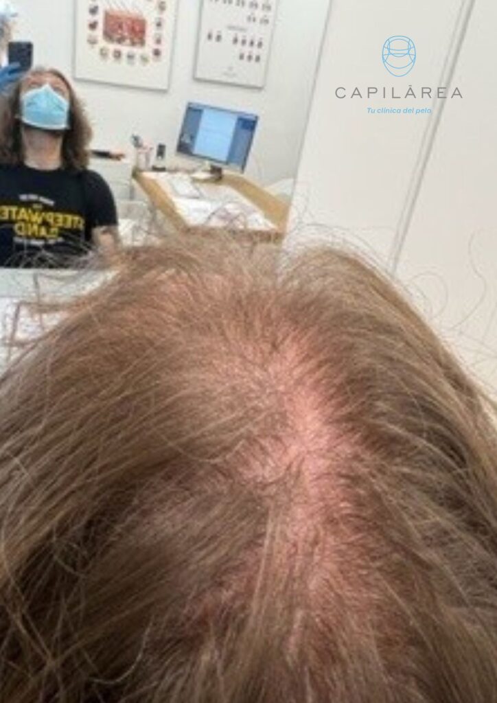 caso alopecia androgenética