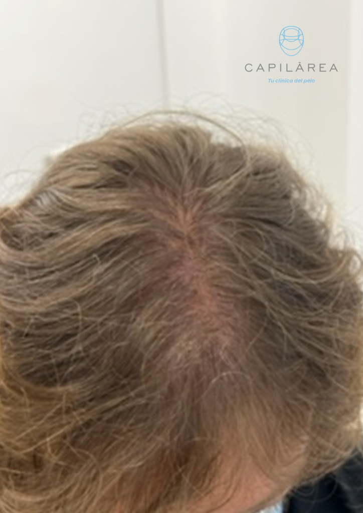 Caso alopecia androgenética tratamiento
