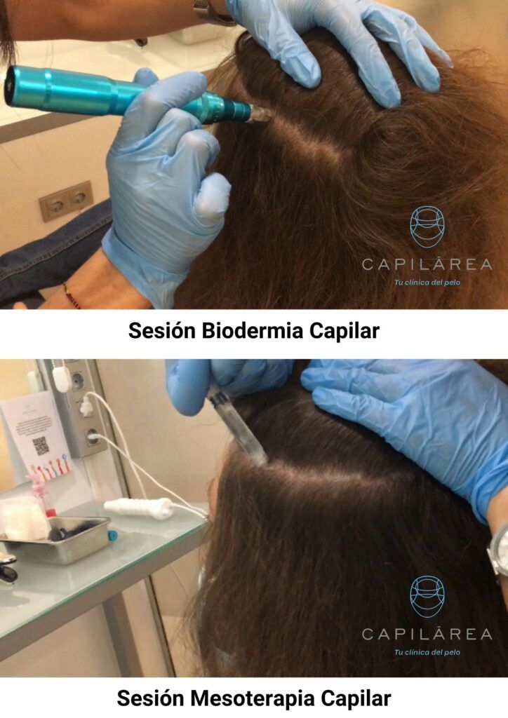 Sesión de biodermia capilar en Capilárea