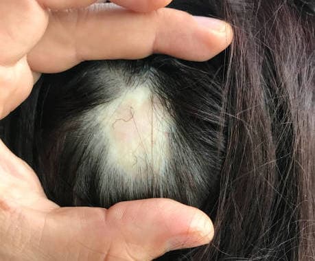 ALOPECIA AREATA en cabello mujer