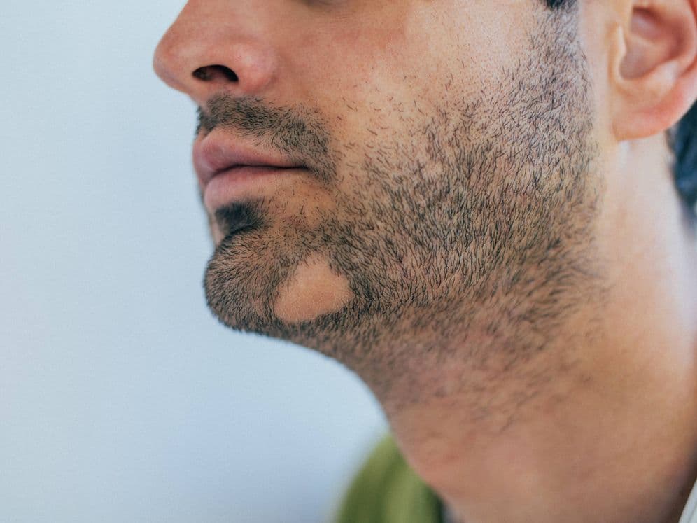 alopecia areata barba hombre