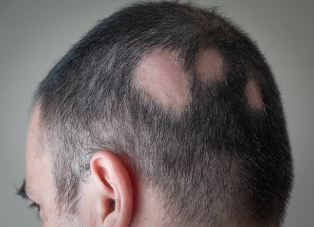 ALOPECIA AREATA: UNA ALOPECIA REVERSIBLE QUE SE PUEDE TRATAR