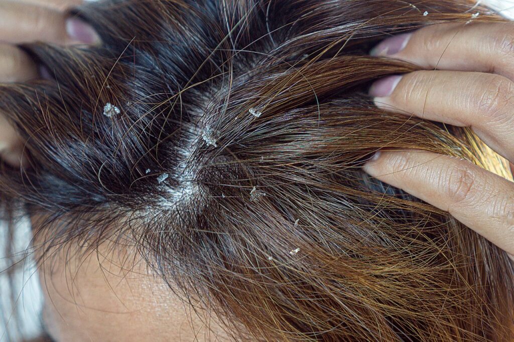Dermatitis seborreica en cabello