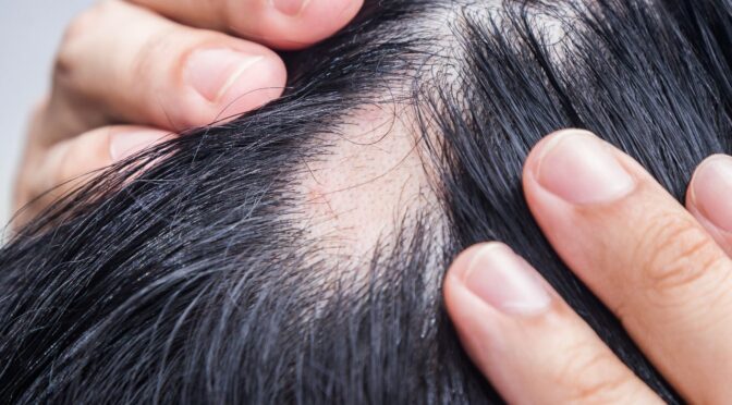 Enfermedades autoinmunes cabello