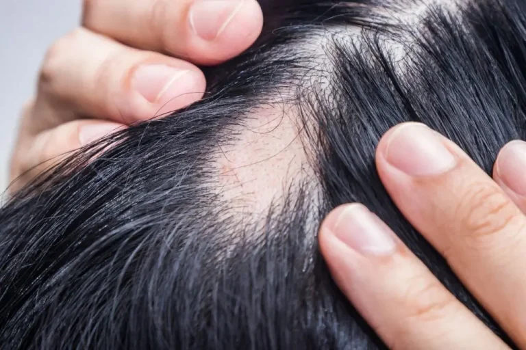 Estas son las enfermedades autoinmunes que provocan la caída del cabello