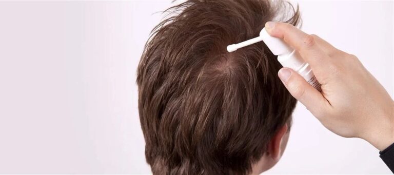 Minoxidil: ¿Para qué sirve? Beneficios y Efectos Secundarios