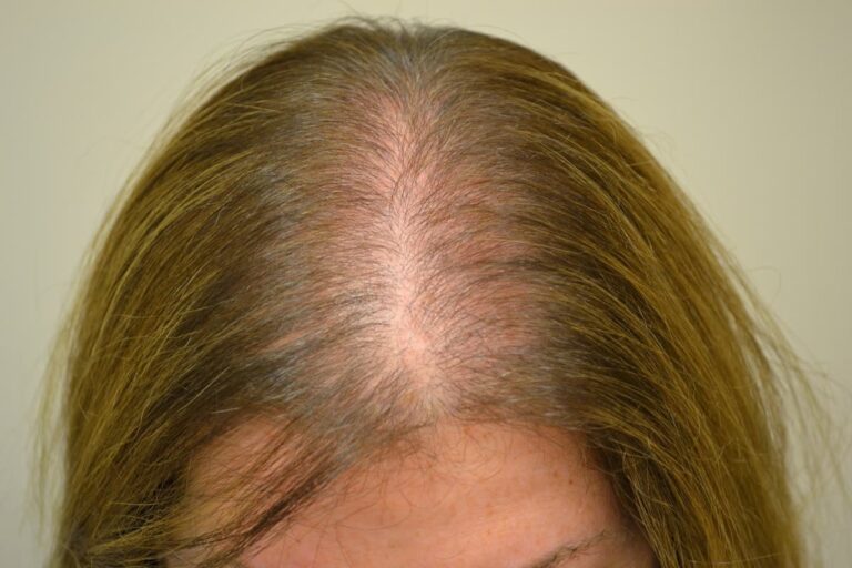Alopecia Androgénica mujer: causas y tratamientos más eficaces