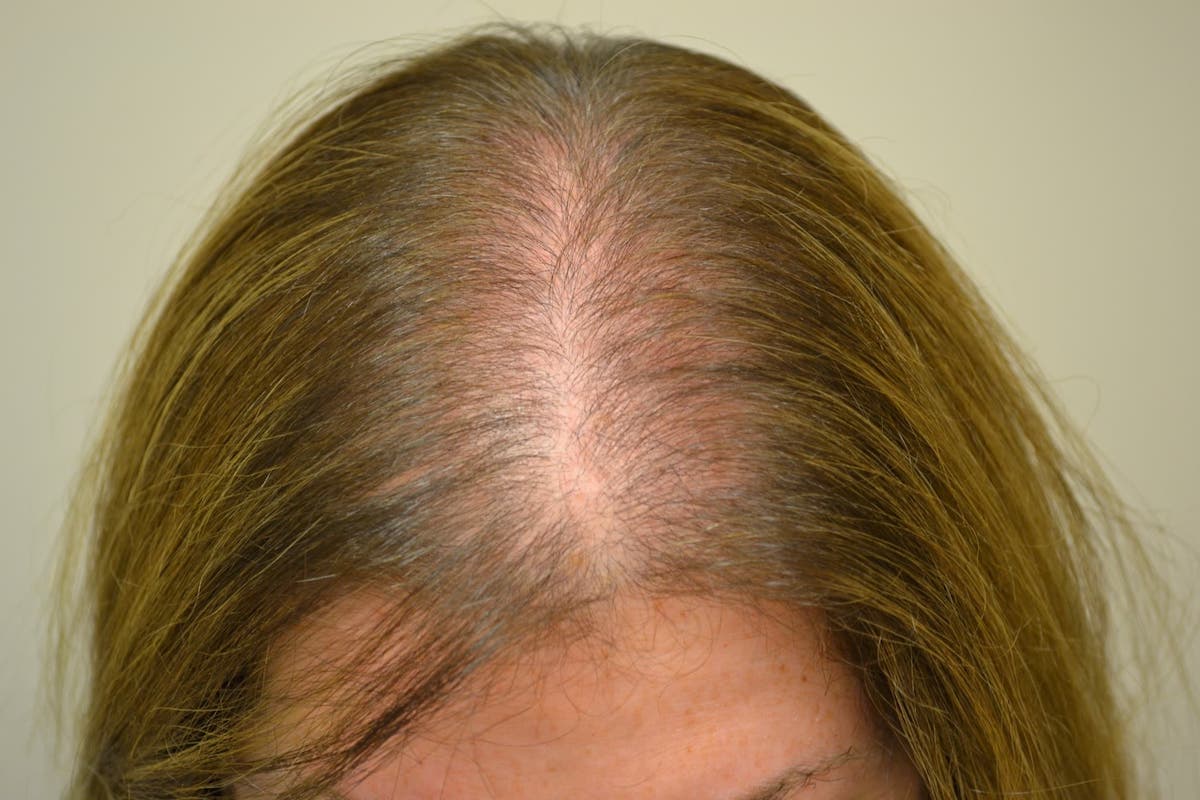 Alopecia Androgénica femenina