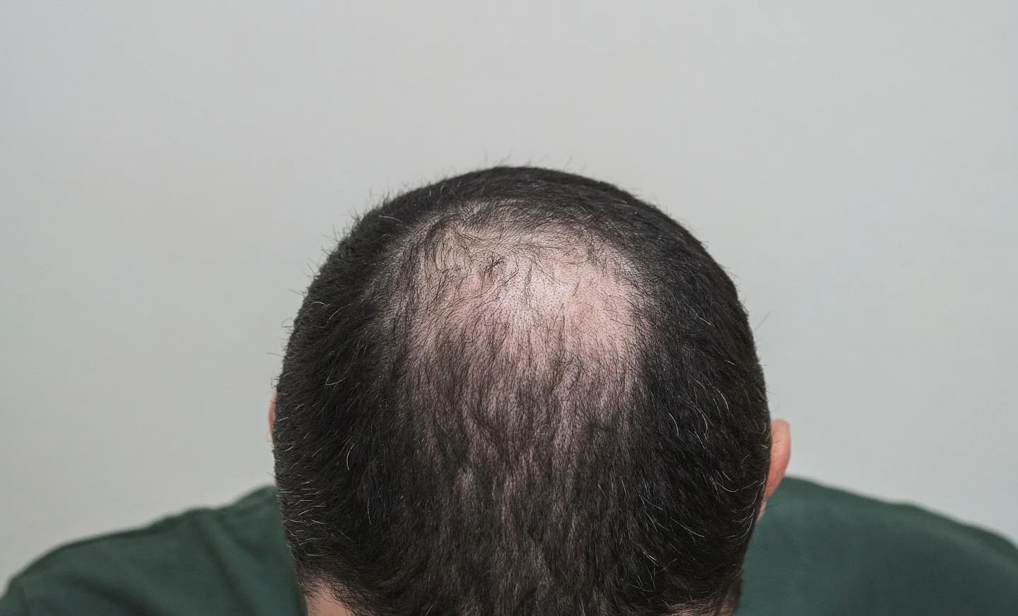 Alopecia Androgénica