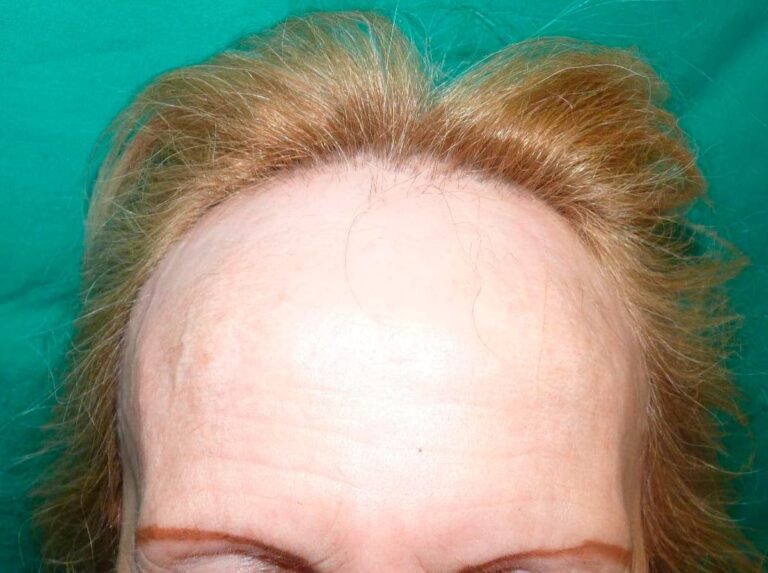 Alopecia Frontal Fibrosante: causas y tratamiento