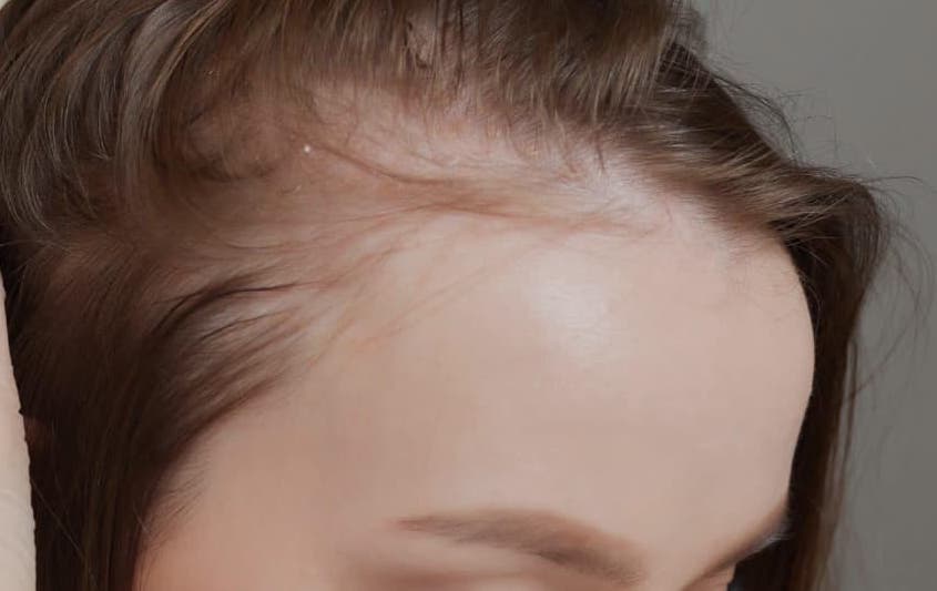 Alopecia Frontal Fibrosante en una mujer