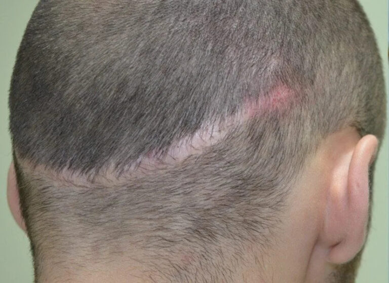 La alopecia cicatricial: causas, diagnóstico y tratamiento
