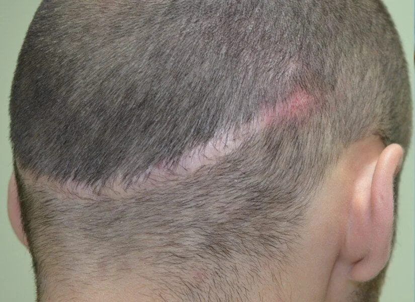 La alopecia cicatricial