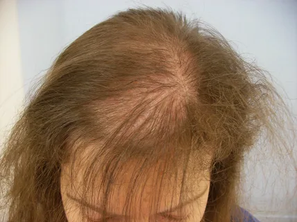 Tratamiento alopecia androgenica femenina