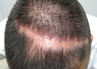 alopecia cicatricial en un hombre