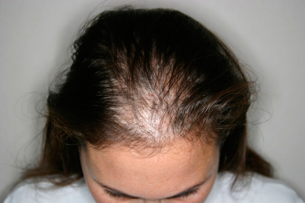 La Alopecia Difusa Femenina