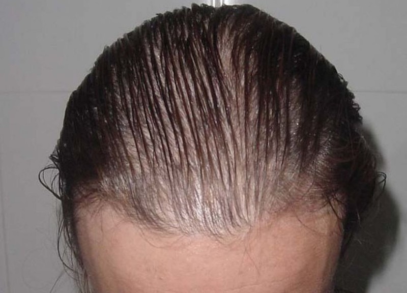 ejemplo de alopecia difusa