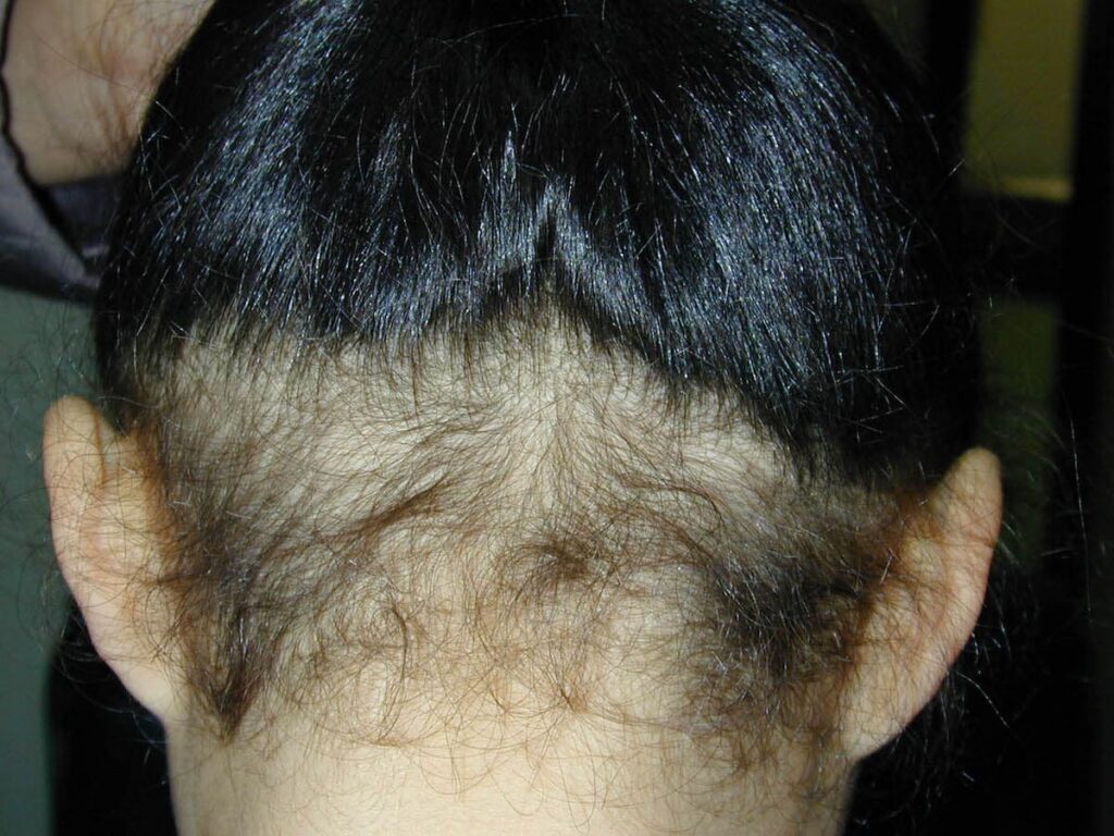 la alopecia difusa