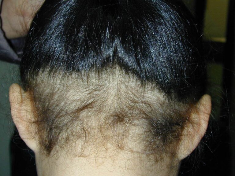 La alopecia difusa: tratamientos para recuperar el pelo