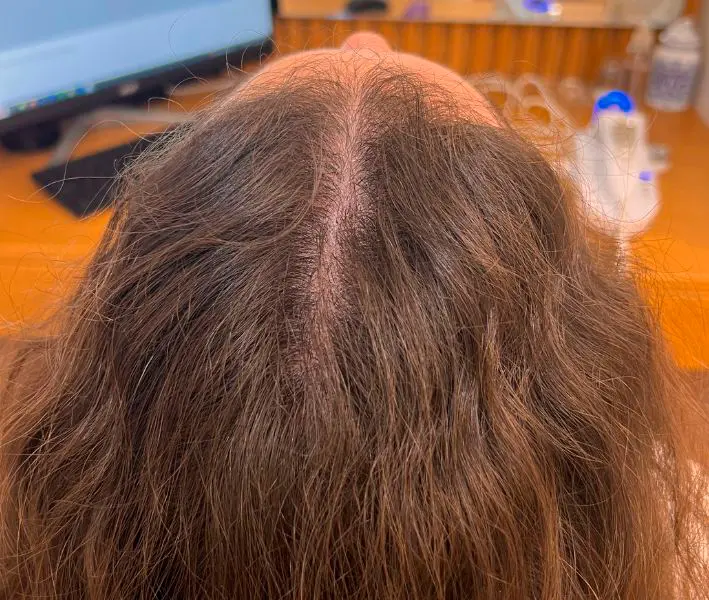 ejemplo Despues alopecia androgenetica