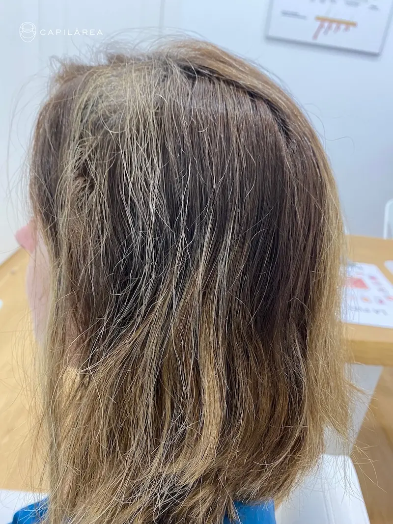 Curación de alopecia areata en un paciente de la clínica capilar capilarea en Madrid