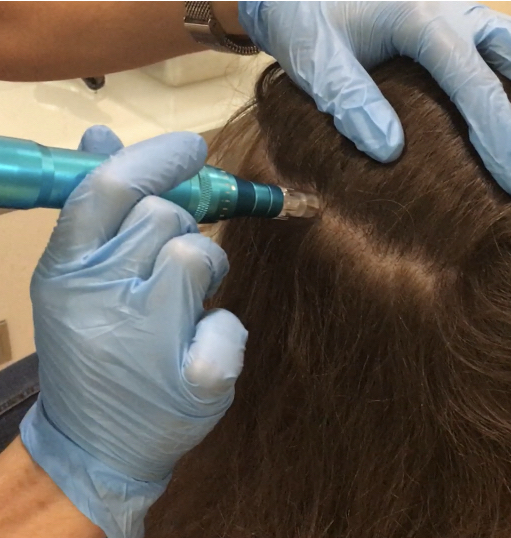 Paciente de la clínica capilárea en un Tratamiento de biodermia en su pelo