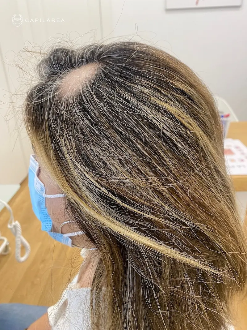 ejemplo de alopecia areata en un paciente de la clínica capilar capilarea