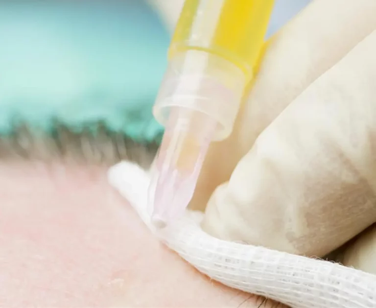 Mesoterapia capilar o PRP en clínicas Capilárea en Madrid