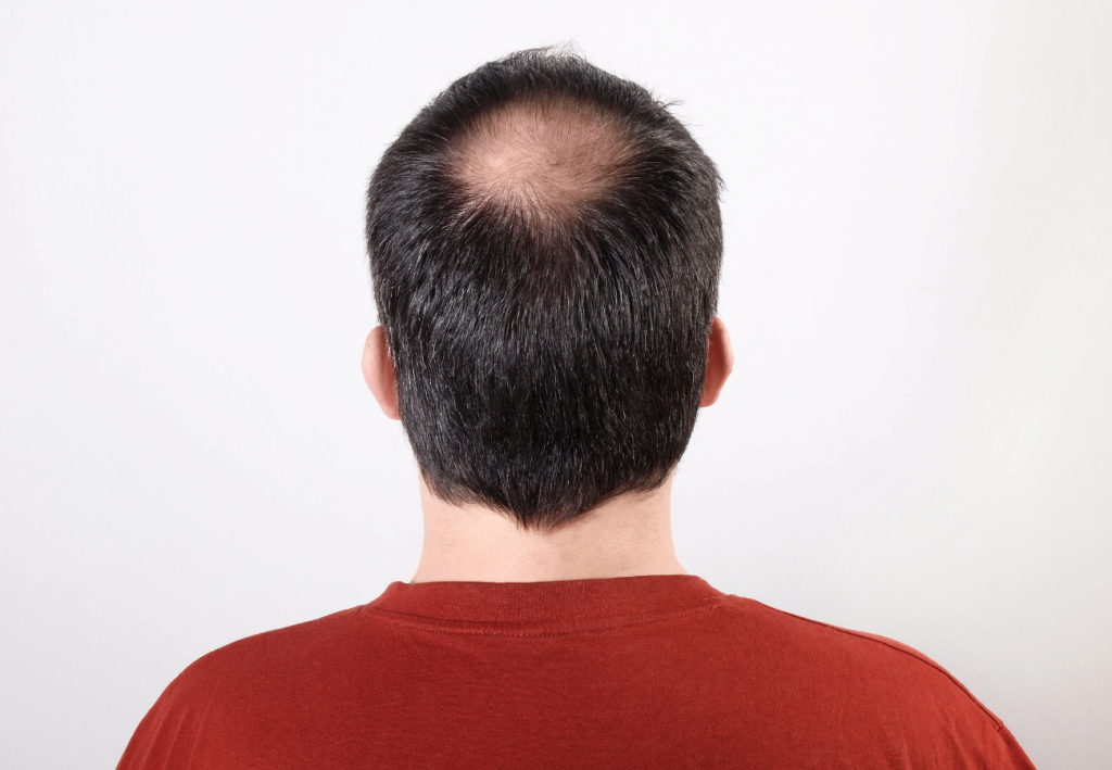 caída del cabello en hombres