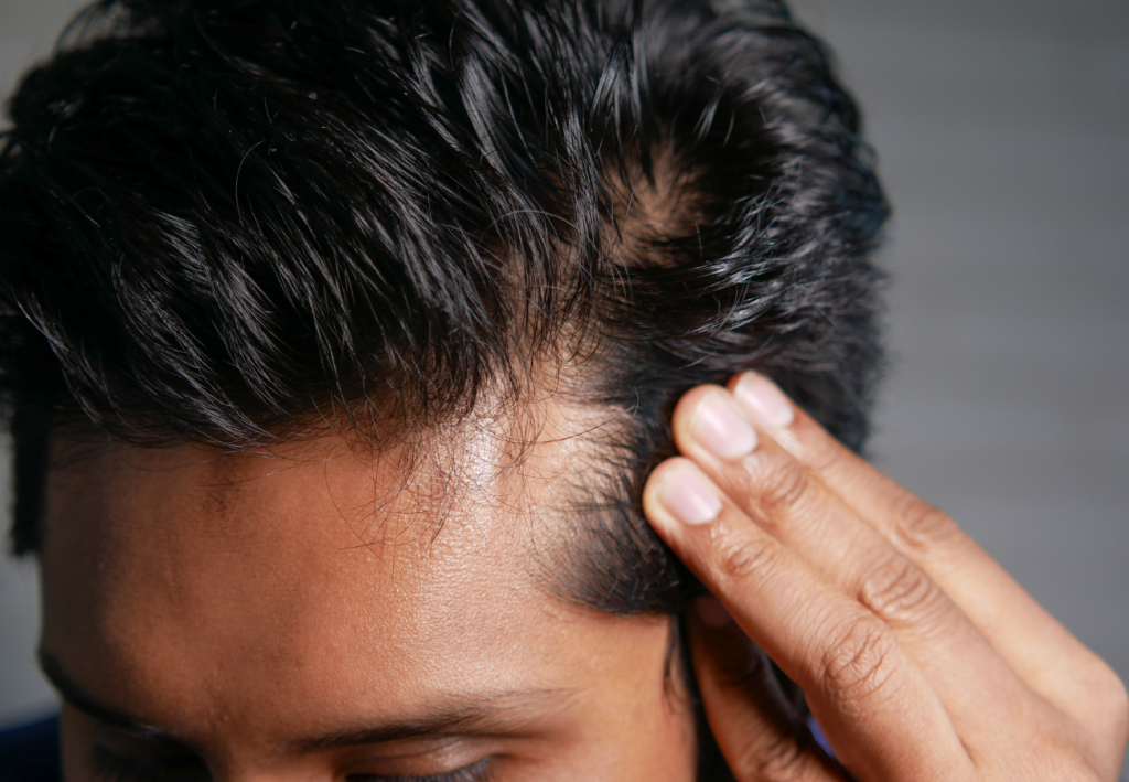 efectos de la creatina sobre la caída del cabello
